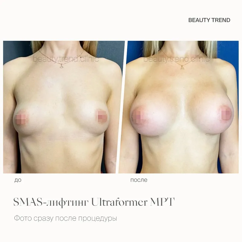 Увеличение груди имплантами, 4А - 3